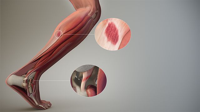 Elmetacin